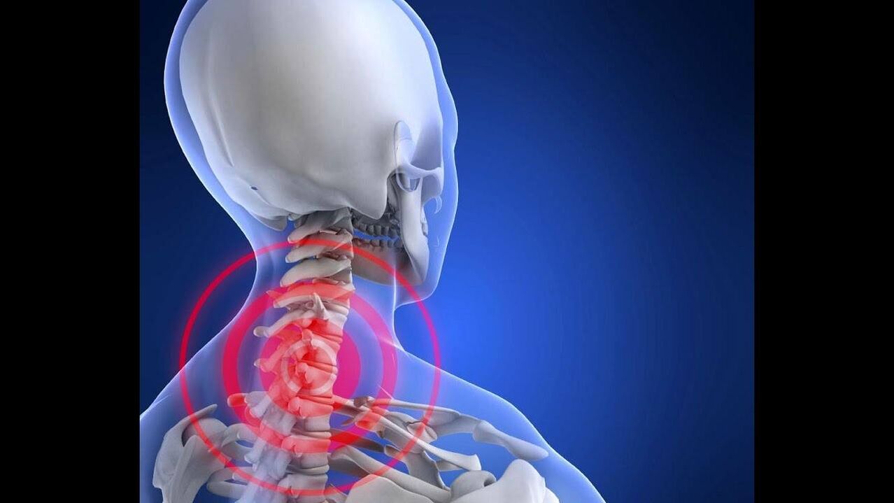 Osteohondroza vratne hrbtenice