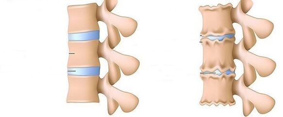 zdravo hrbtenico in osteohondrozo