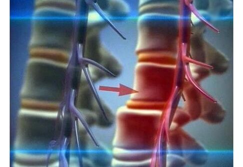 Stiskanje živčnih končičev pri ledveni osteohondrozi