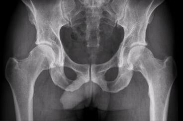 Diagnostične možnosti za artrozo kolčnega sklepa