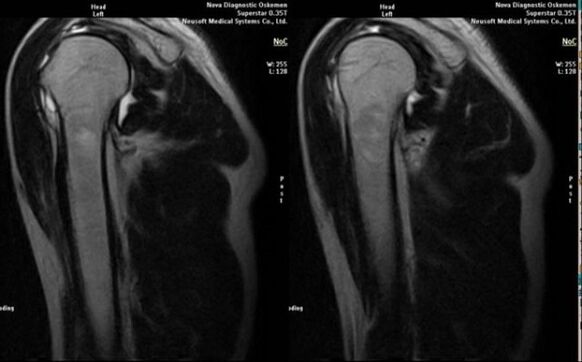 Rentgen za diagnosticiranje artroze ramenskega sklepa
