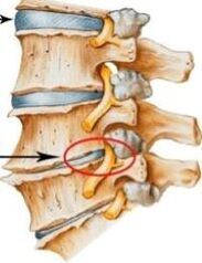 osteohondroza vratne hrbtenice