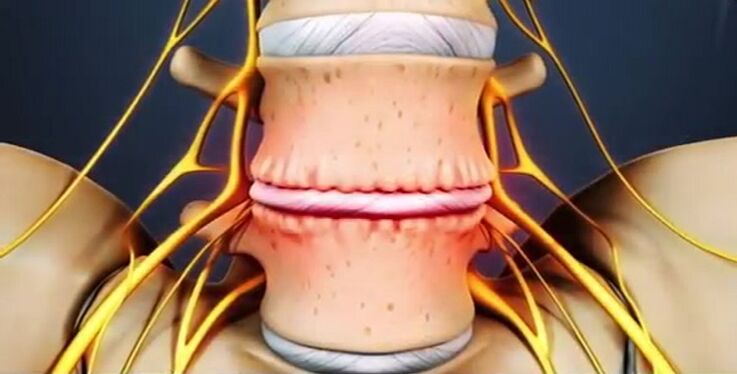 poškodbe hrbtenice zaradi osteohondroze